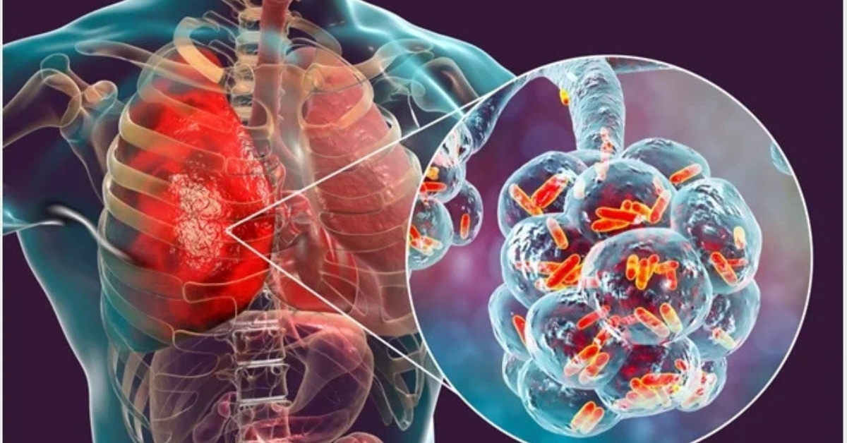 Effective Strategies for Chest Infection Management